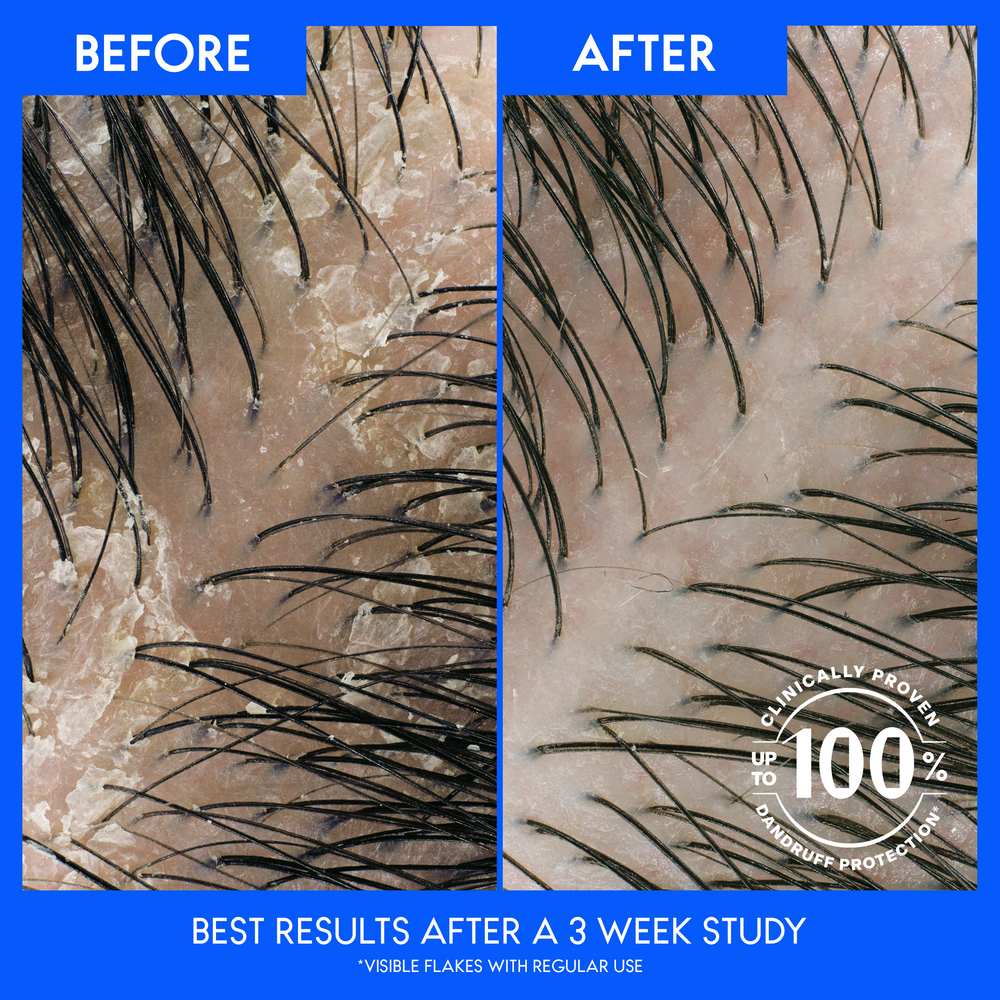 HEAD & SHOULDERS Pyritinol Zinc Dandruff Shampoo + Conditioner Apple Cider Vinegar شامبو وبلسم هيد اند شولدرز بخل التفاح