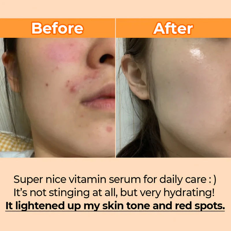 NUMBUZIN 5 goodby blemish serum سيروم علاج التهيج من نمبوزين