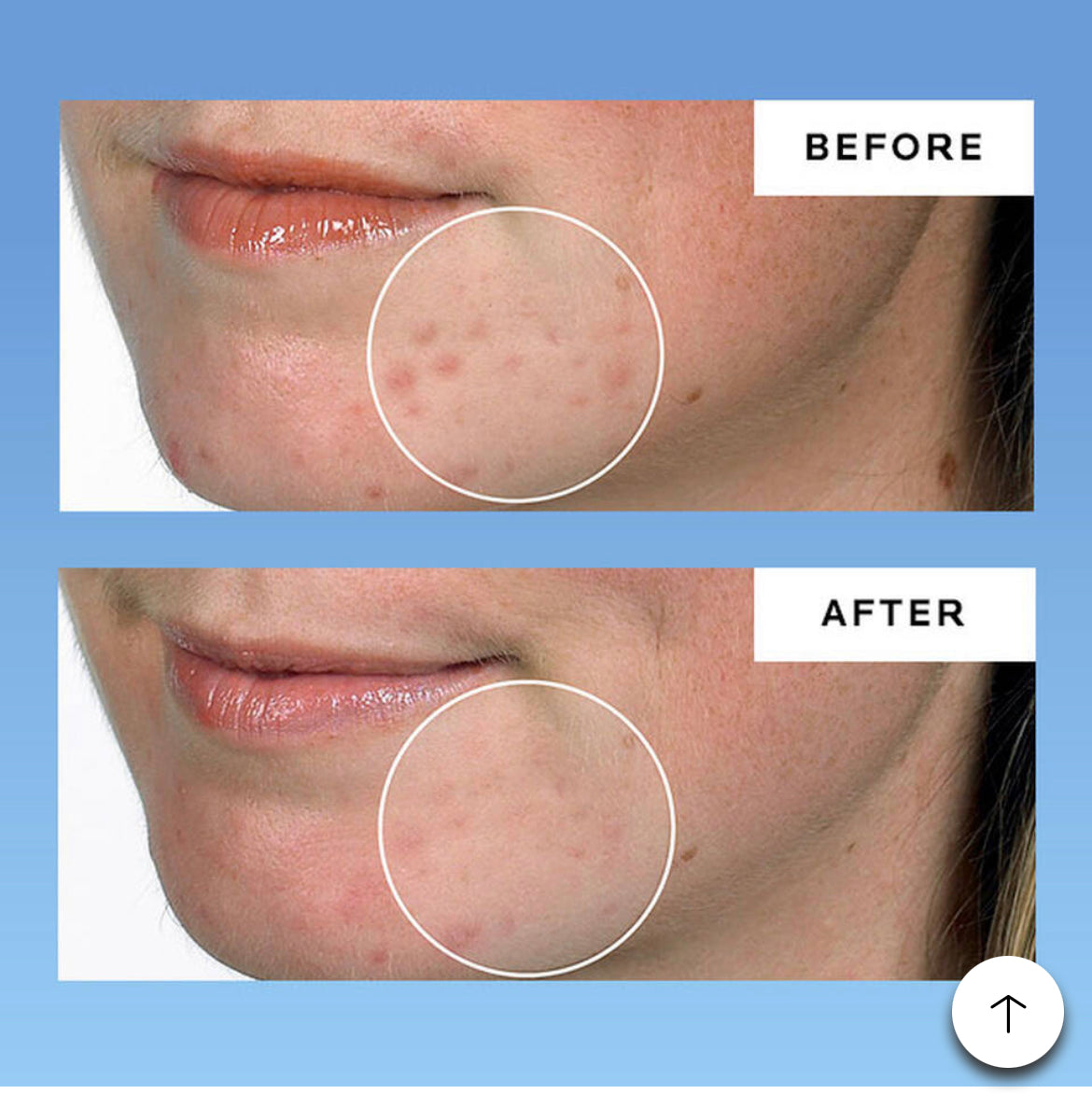 LA ROCHE POSAY  Effaclar Dermatological Acne 3-Step System بكج معالج حب الشباب
